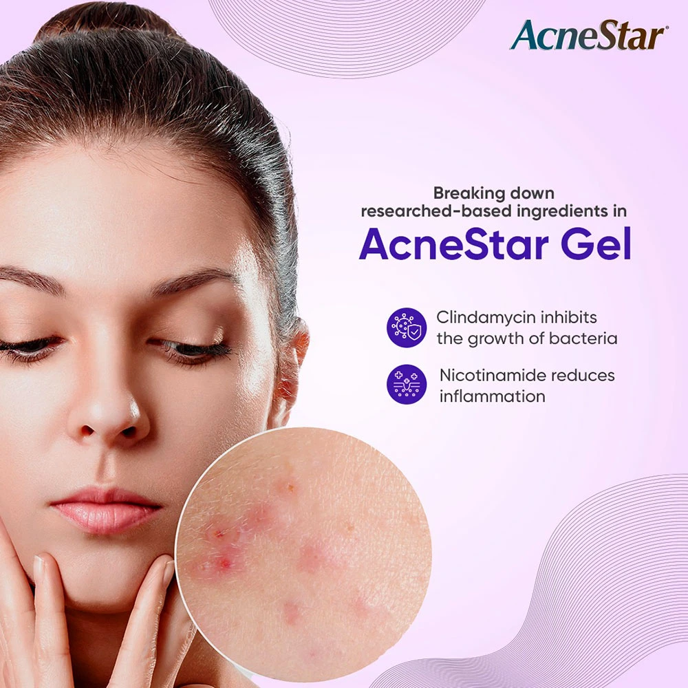 AcneStar Gel Cream For Pimples 15gm