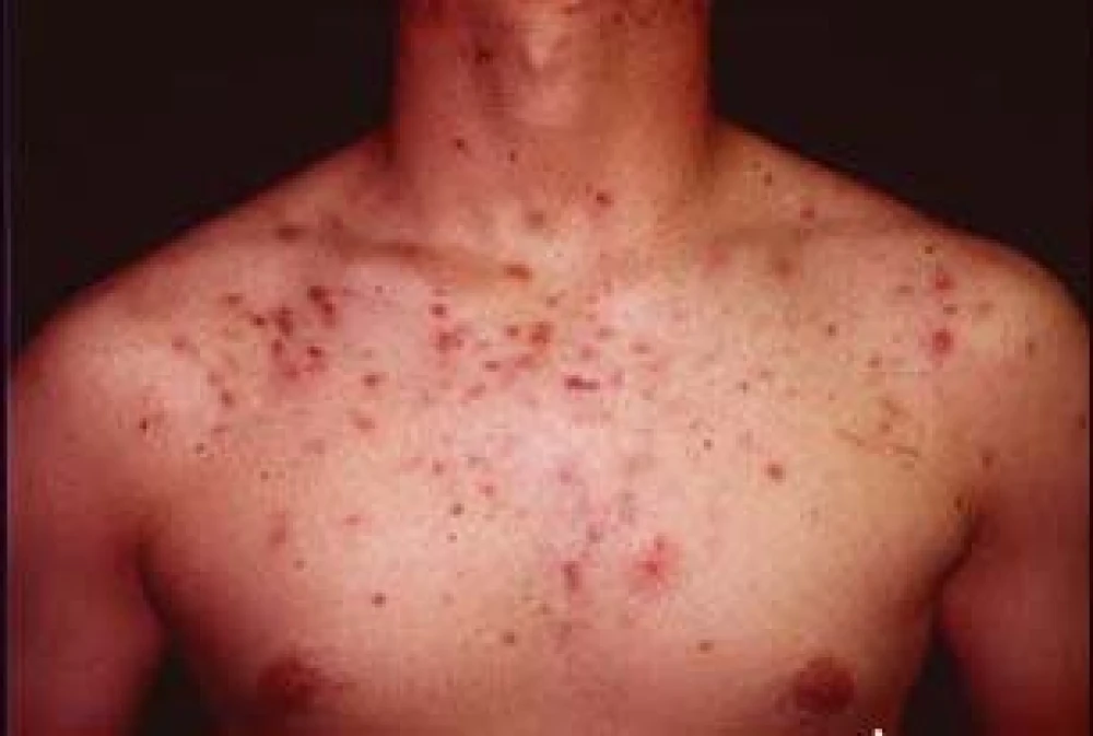 OxeCure Body Acne Spray 50ml