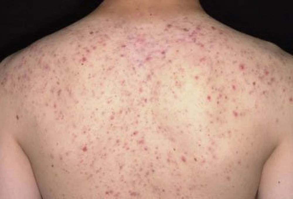 OxeCure Body Acne Spray 50ml