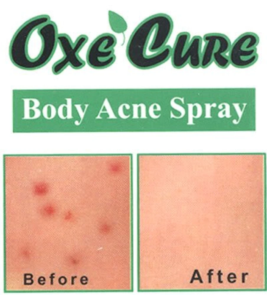 OxeCure Body Acne Spray 50ml